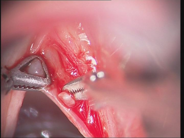 Fotos clínicas: Microcirugía endolaríngea. Quiste